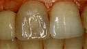 Verfärbte Zähne